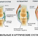 Разновидности артрита