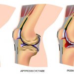 Схема артрита локтевого сустава