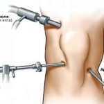 Схема артроскопии