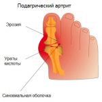 Схема подагрического артрита суставов