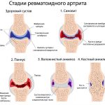 Стадии развития ревматоидного артрита