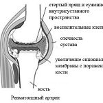 Схема ревматоидного артрита
