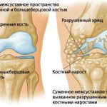 Инфекционный артрит