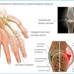 Патология развития ювениального ревматоидного артрита