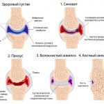 Стадии артрита